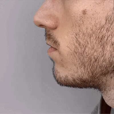 Rylaro™ Dispositivo de luz vermelha nasal